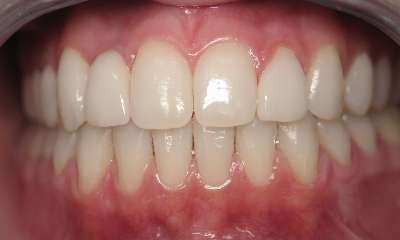 Smile-Makeover-After-Image