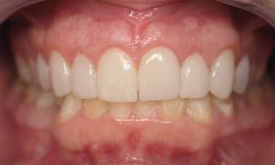 Smile-Makeover-After-Image