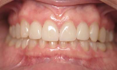 Porcelain-Veneers-Crowns-After-Image