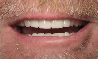 Porcelain-Veneers-Crowns-After-Image