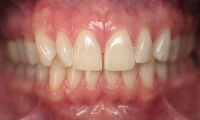 Teeth-Whitening-After-Image