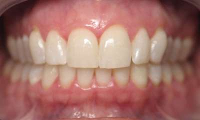 Teeth-Whitening-After-Image