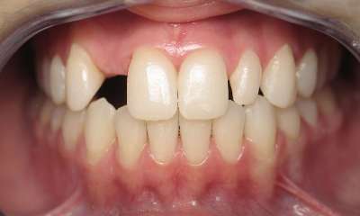 Smile-Makeover-Before-Image