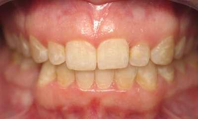 Smile-Makeover-Before-Image