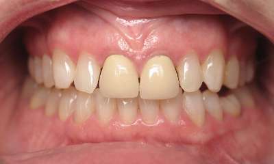 Porcelain-Veneers-Crowns-Before-Image