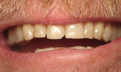 Porcelain-Veneers-Crowns-Before-Image