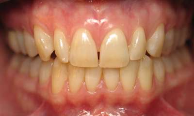 Teeth-Whitening-Before-Image