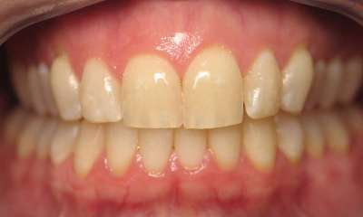 Teeth-Whitening-Before-Image